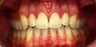 Invisalign