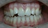 Invisalign