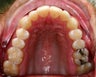 Invisalign