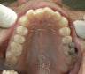 Invisalign