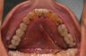 Invisalign