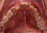 Invisalign