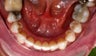 Invisalign