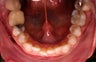 Invisalign