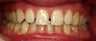 Invisalign