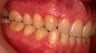Invisalign