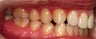 Invisalign