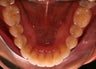 Invisalign