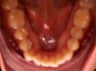 Invisalign
