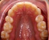 Invisalign