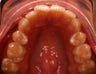 Invisalign
