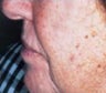 Skin Tightening