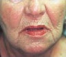 Skin Tightening