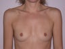 Breast Implants