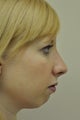 Rhinoplasty