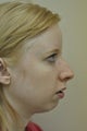 Rhinoplasty