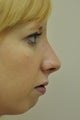 Rhinoplasty