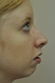 Rhinoplasty