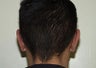 Otoplasty