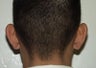 Otoplasty