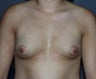 Breast augmentation