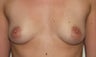 Breast Implants