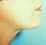 Liposuction of the neck
