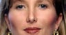 Rhinoplasty