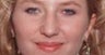 Rhinoplasty