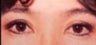 Eyelid Surgery
