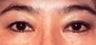 Eyelid Surgery
