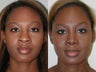 African American Rhinoplasty