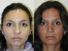 Rhinoplasty