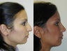 Rhinoplasty