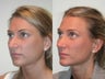 Rhinoplasty