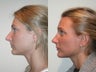 Rhinoplasty