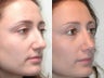 Rhinoplasty