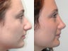 Rhinoplasty