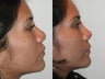 Revision Rhinoplasty Hispanic Female