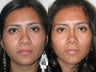 Revision Rhinoplasty Hispanic Female