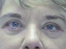Lower Lid Blepharoplasty