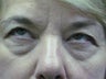 Lower Lid Blepharoplasty