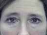 Lower Lid Blepharoplasty