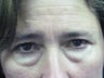 Lower Lid Blepharoplasty