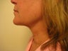 Laser Liposuction