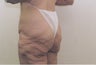 Body Lift