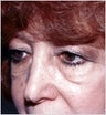 Eyelid Surgery