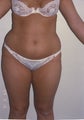 Liposuction