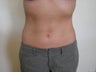 Liposuction