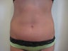 Liposuction